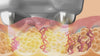 Lipotherm Education short
